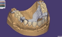 exocad® DentalCAD software