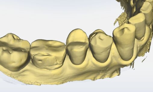 Gingival Recession Measurement after eight months
