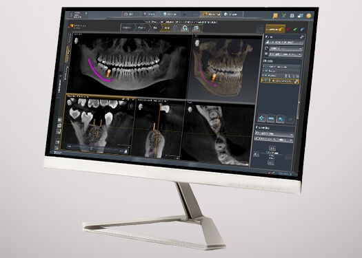 Monitor showing the Dental Software SICAT Implant