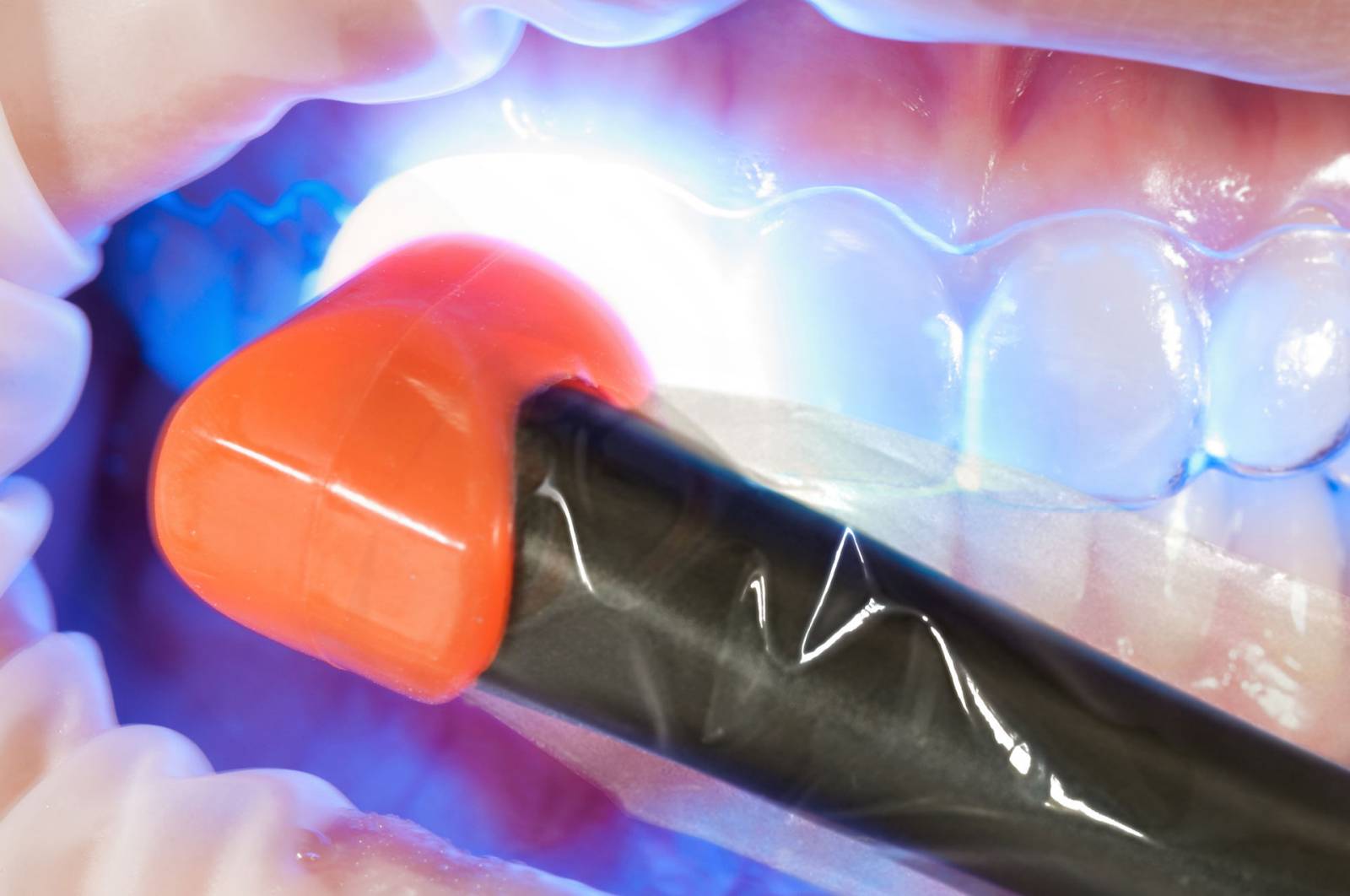 RES-Image-SpectraST-SureSmileAligners-Workflow-Step5.jpg
