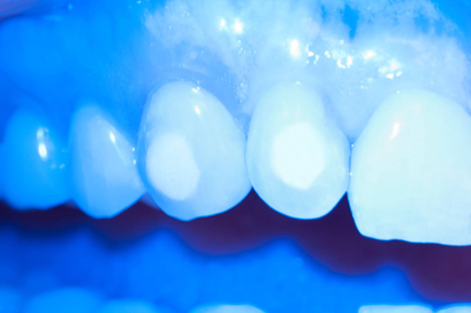 RES-Image-SpectraST-SureSmileAligners-Workflow-Step6.jpg