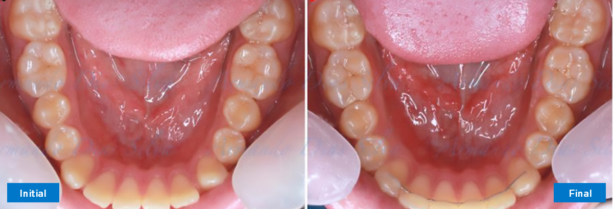 Lower Occlusal