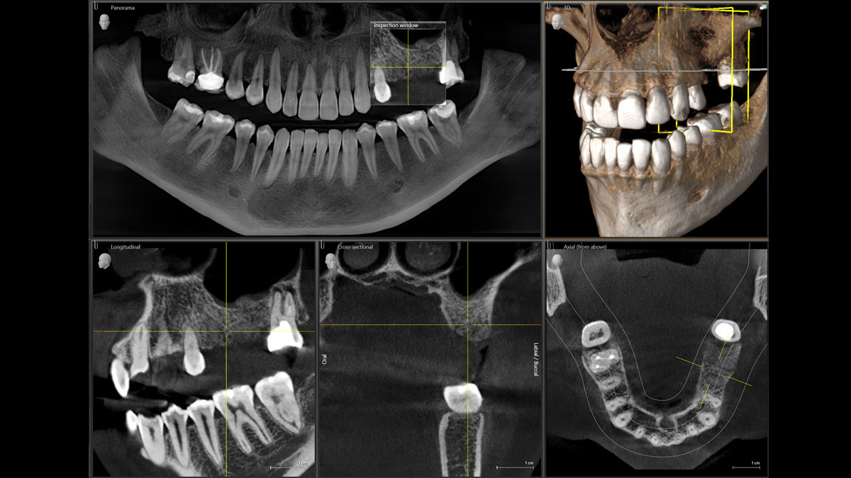 Dental X-Ray of an implant case