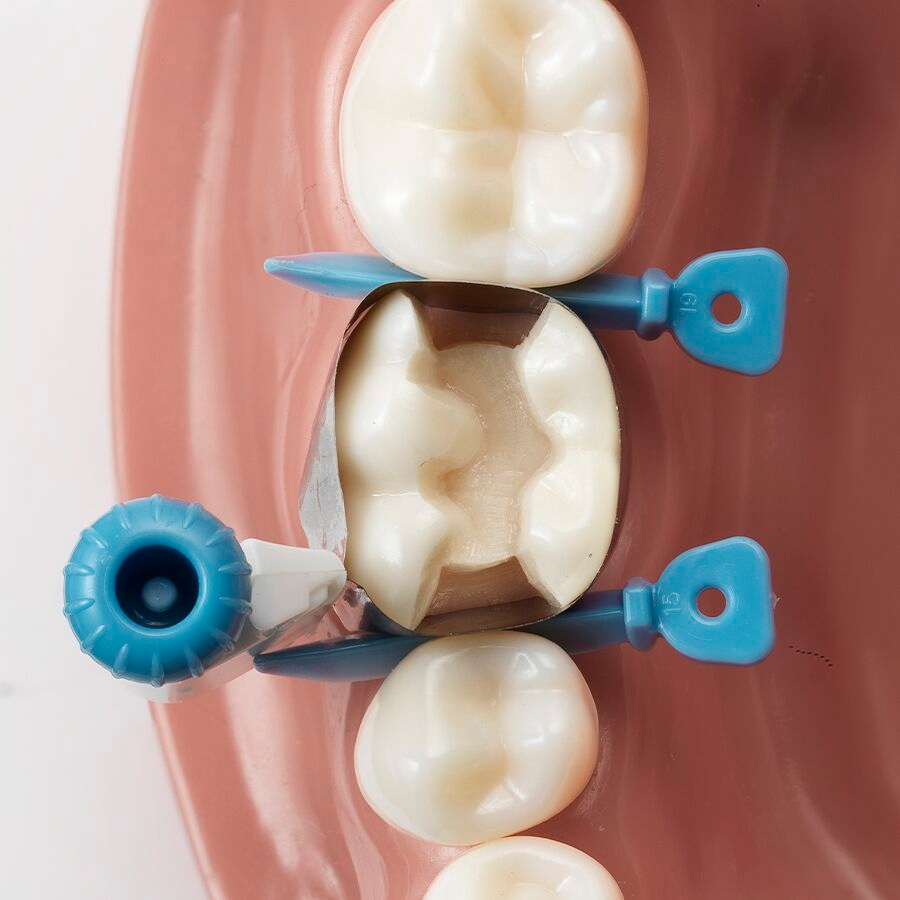 placement option of circumferential dental matrix