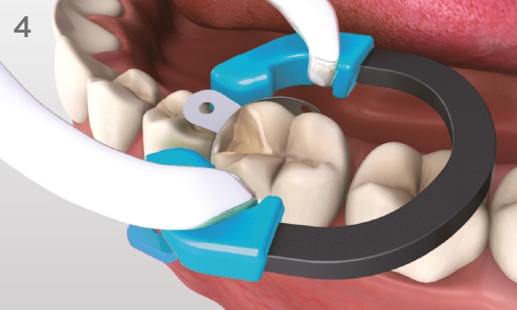 Place Palodent Plus ring on top