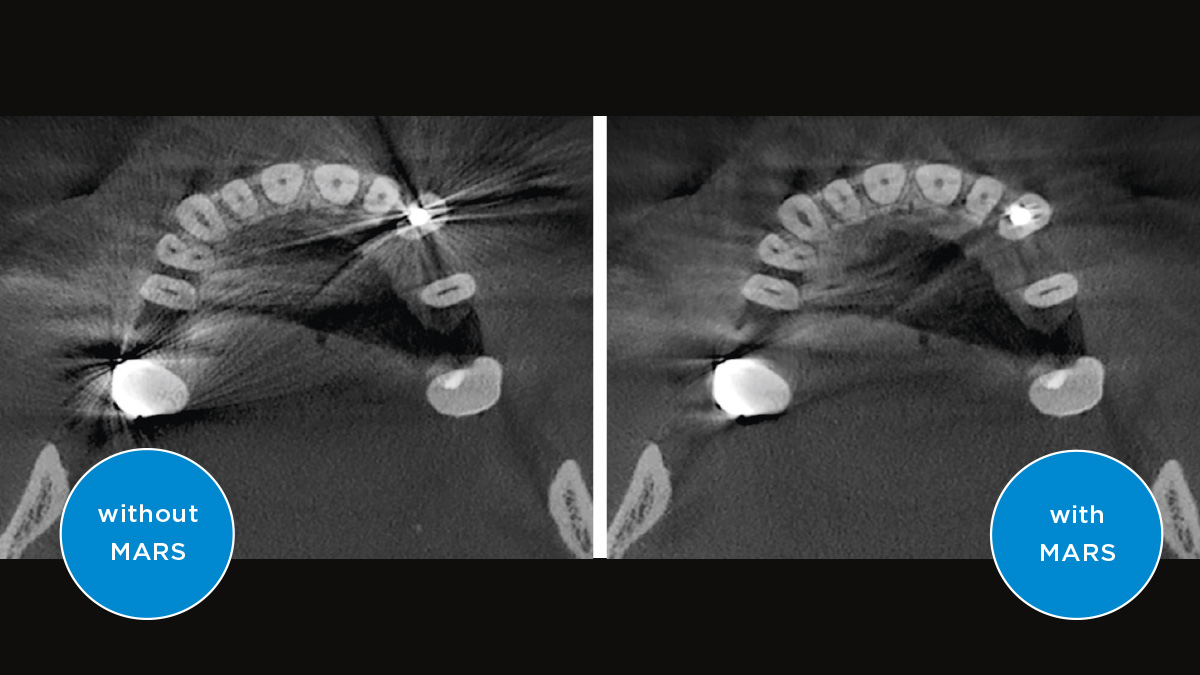  Metal Artefact Reduction Software: