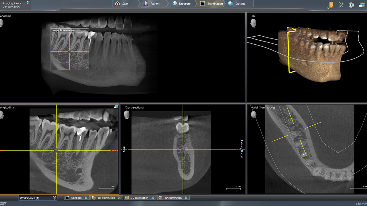 Intelligent Low Dose Indication Example in Sidexis 4