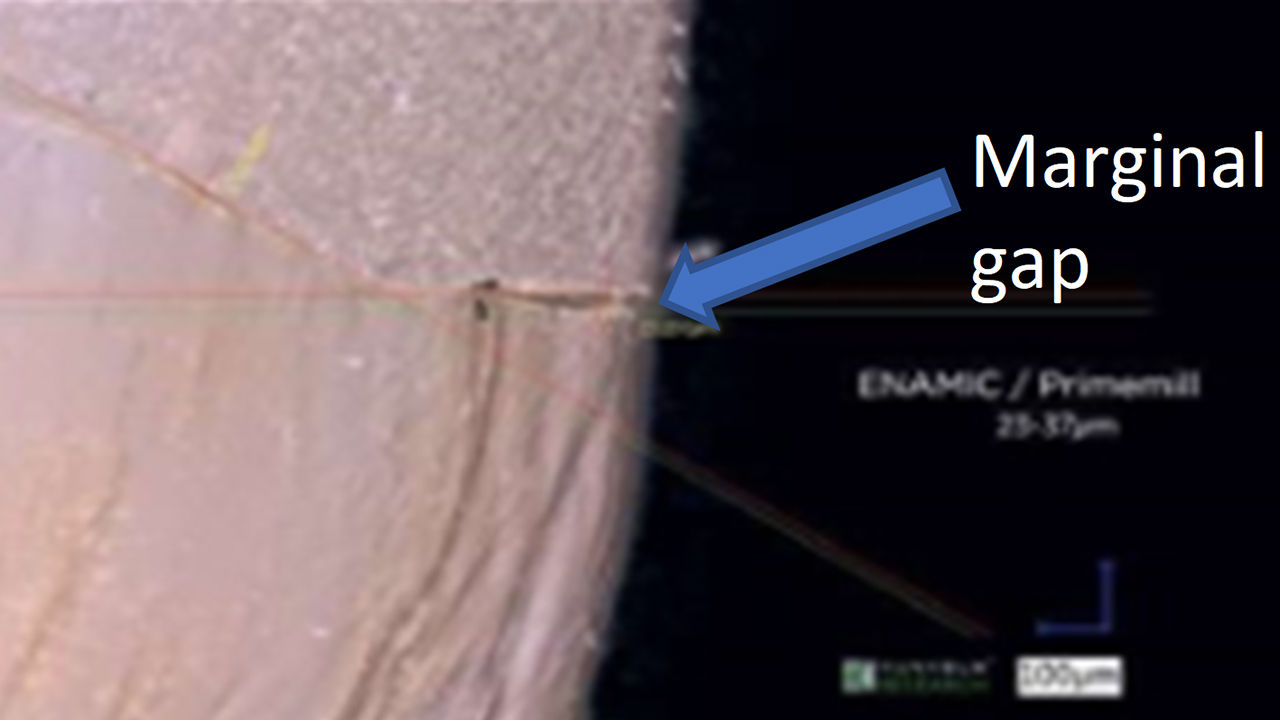 Figure 1 Clinical survival [years] of 676 endodontically treated posterior teeth and cavities with up to three surfaces (three to four remaining walls) by Dammaschke T. et al., 2013 6