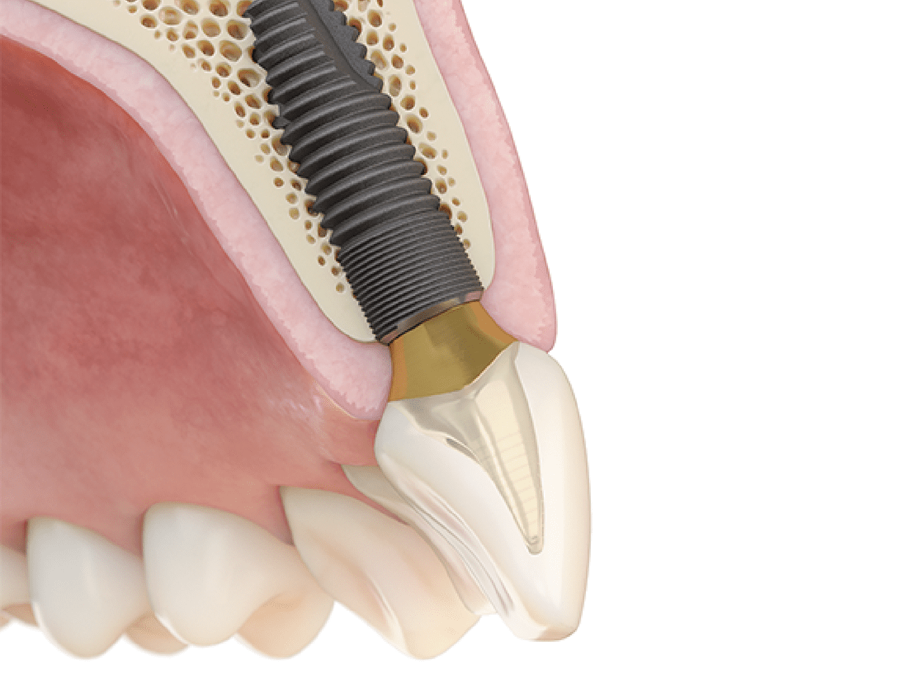 Dental Implants Course Series I Dentsply Sirona USA
