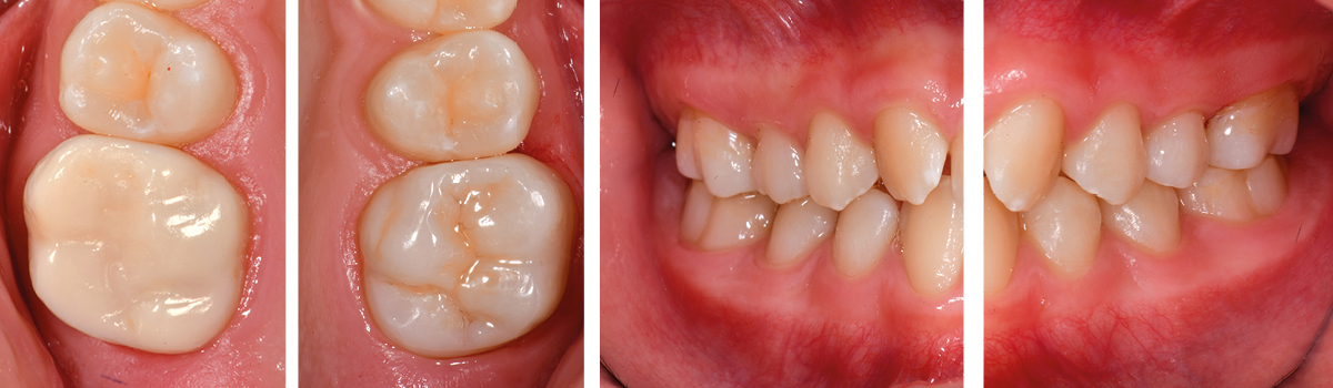 MIH Teeth Treatment: CEREC Tessera Restoration | Dentsply Sirona USA