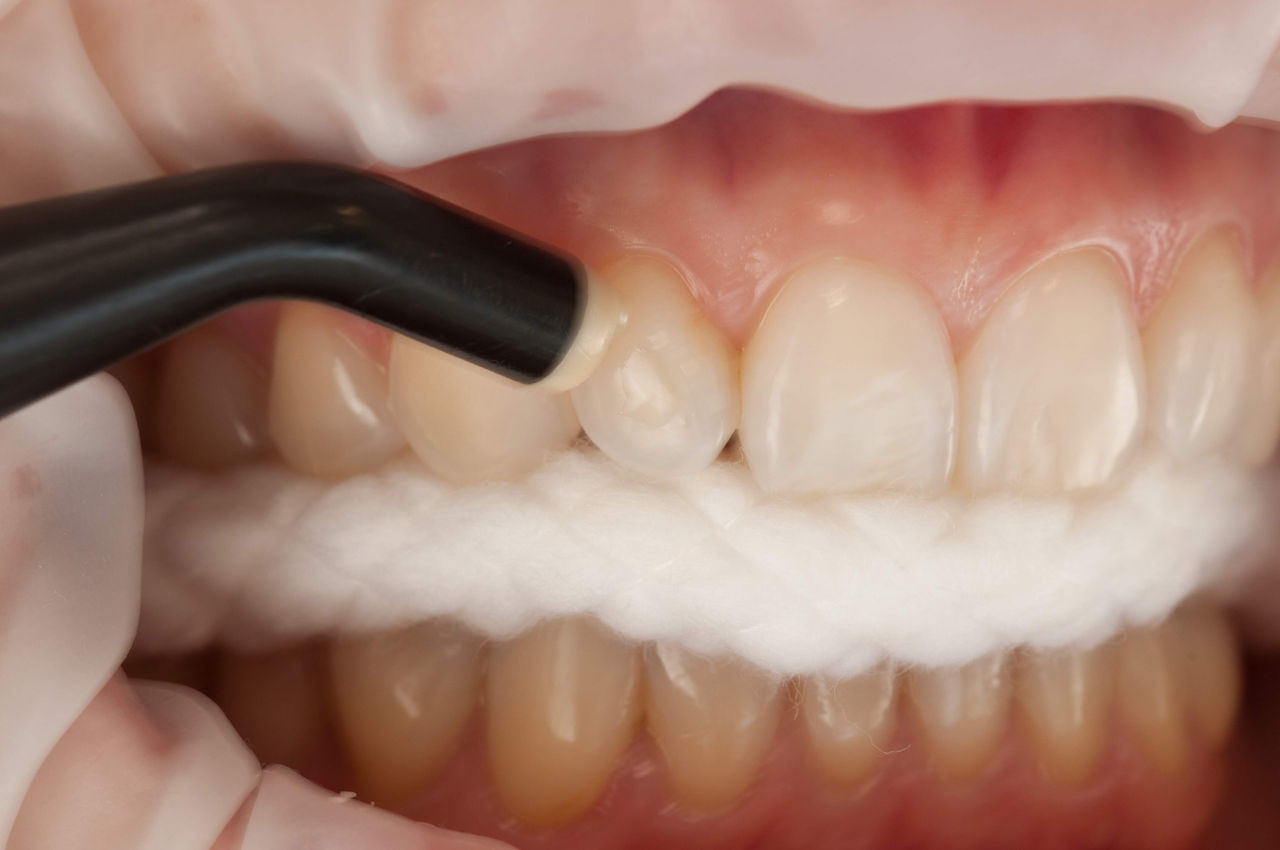 SureSmile Attachment Bonding with TPH Spectra® ST Dentsply Sirona USA