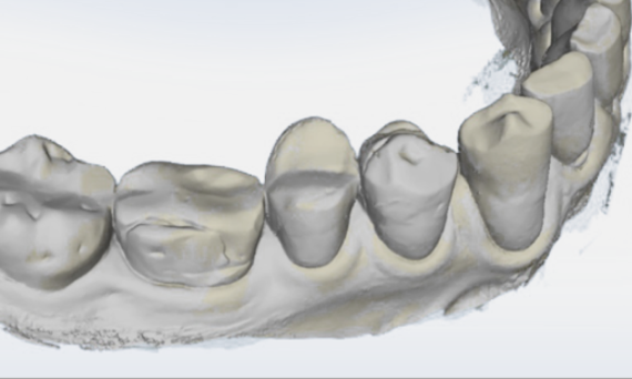 Gingival Recession Measurement, before, OraCheck 5