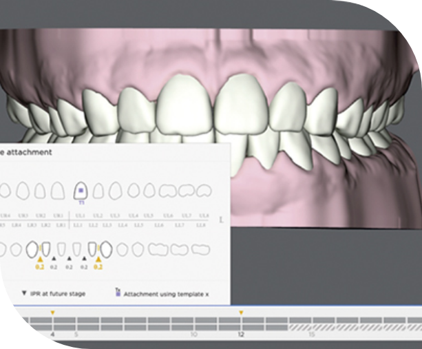 SureSmile Aligners Workflow USA