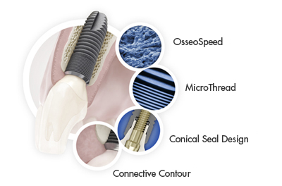 Dental Implant Parts | Dentsply Sirona USA USA