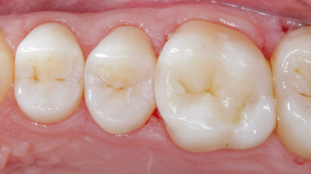 Class II Dental Cases | Dentsply Sirona USA