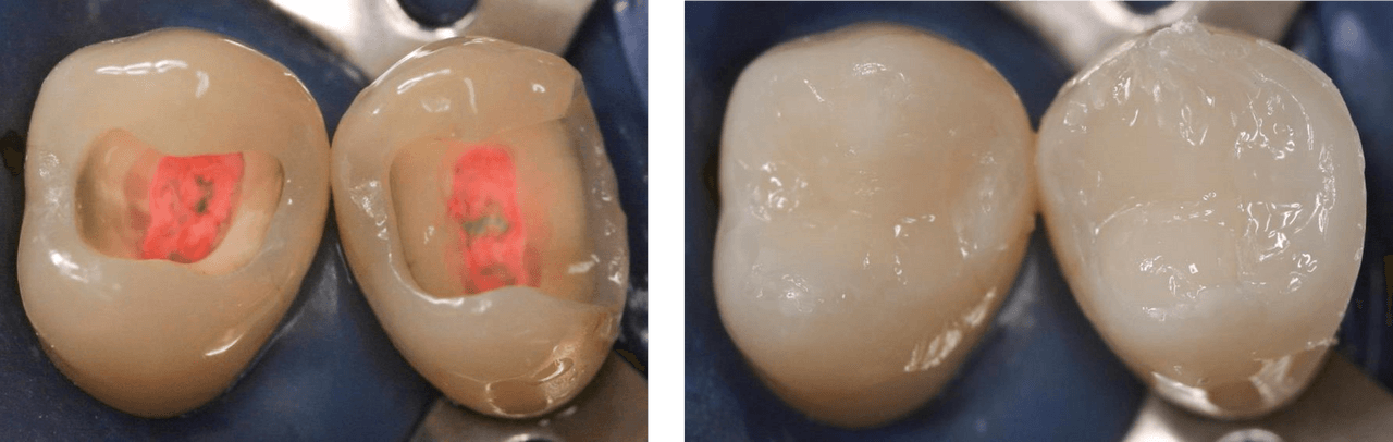 Figure 2: Endodontically treated posterior teeth with four and three coronal walls, and barely undermined residual tooth structure before and after direct restoration (Courtesy of Dr. Marcus Holzmeier, Germany)
