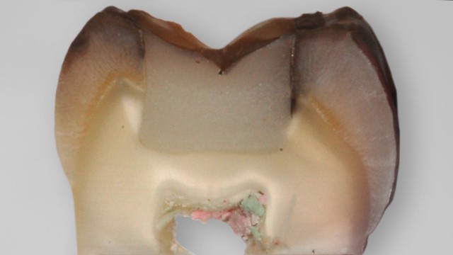 Tooth with microleakage