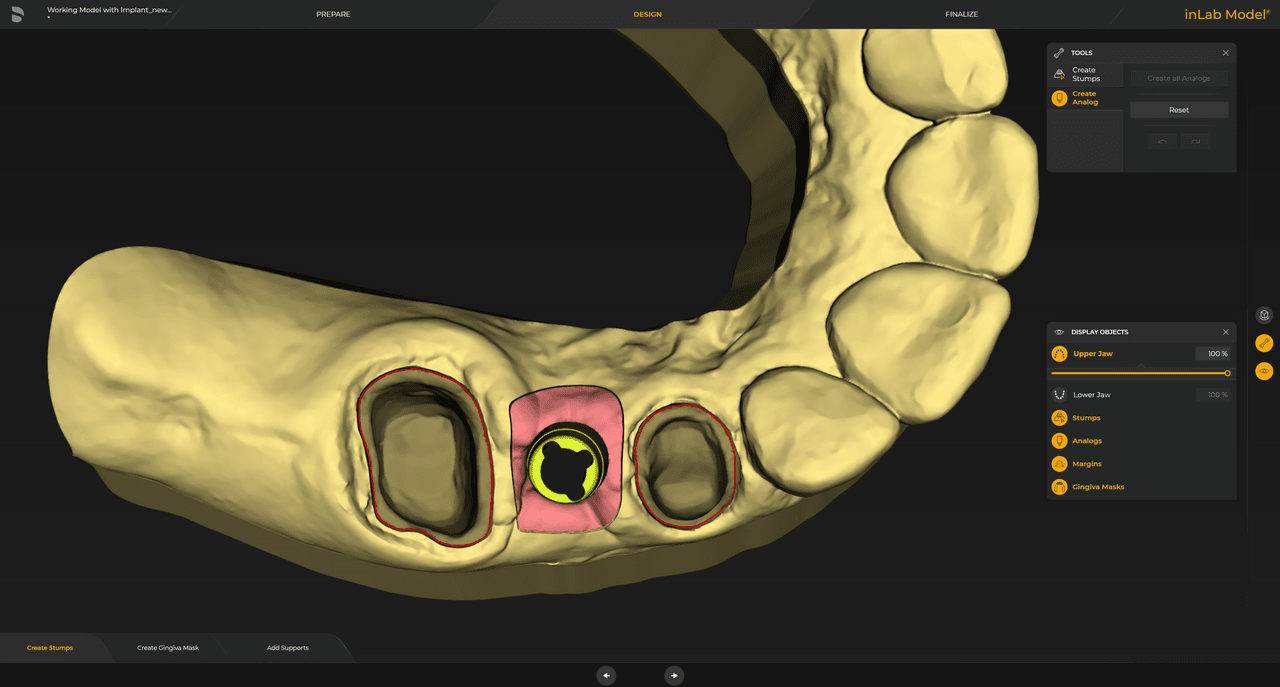 For implant models, the selected digital implant analog is automatically included in the calculation and visualized in the software.