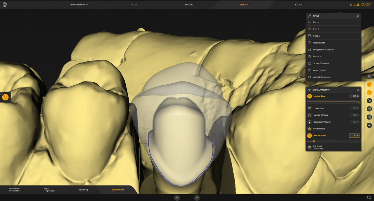 Virtual insertion  for designing several restoration layers in complex cases.