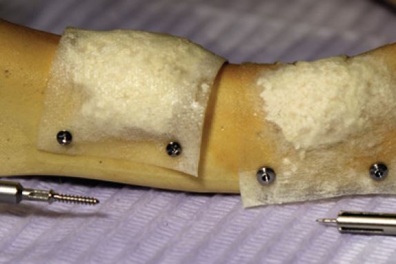 jaw bone with lingual flap