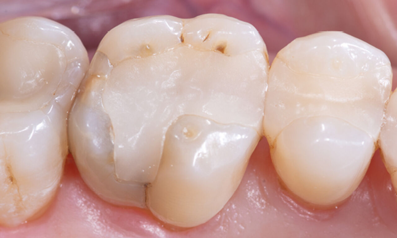 Composite filling, tooth 16, before CEREC treatment