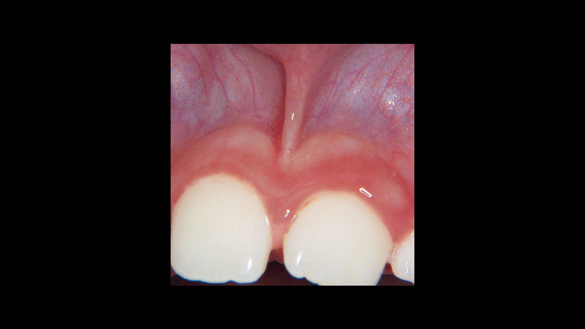 Diode Laser Treatment Videos Dentsply Sirona Global