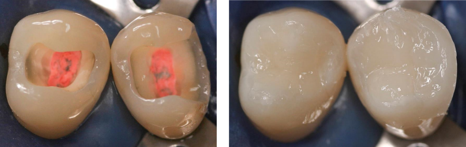 Figure 2: Endodontically treated posterior teeth with four and three coronal walls, and barely undermined residual tooth structure before and after direct restoration (Courtesy of Dr. Marcus Holzmeier, Germany)