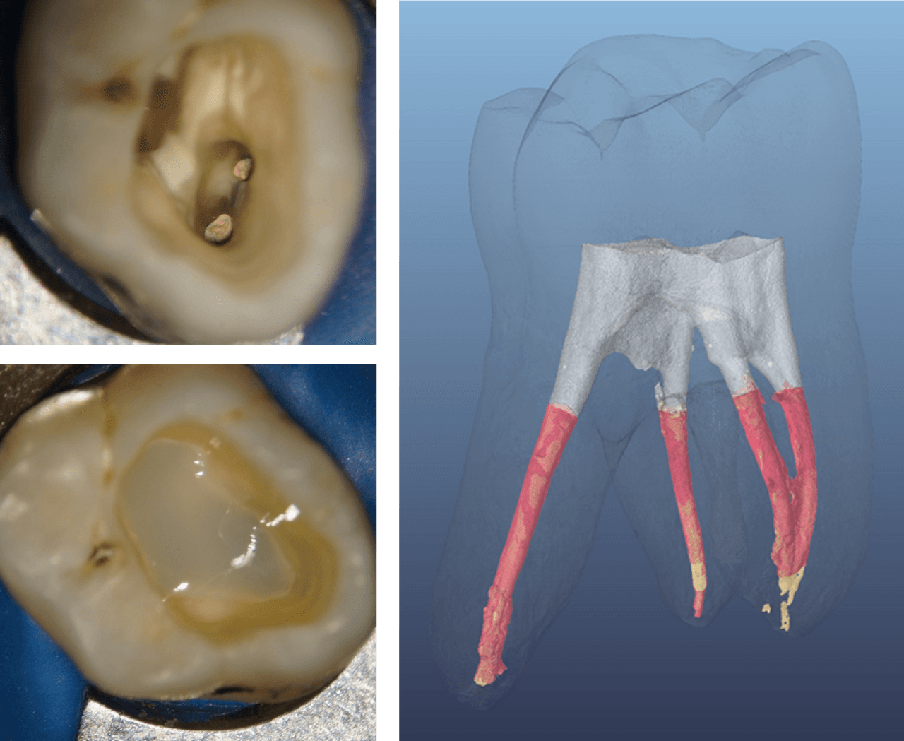 Figure 4 Analysis of the initial SDR flow+-layer in a post-endodontic Class I cavity, using a micro-CT. The SDR flow+-layer (grey) shows a tight seal to the cavity walls as well as an excellent adaptation to the obturation material (red). (Image source: Paqué F., 2014 (ref. 14.1483))