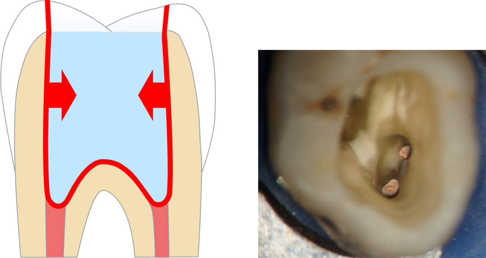 Large quantities of filling material need to be placed in posterior post-endodontic cavities, which can create significant shrinkage stress through the amount of bonded surfaces