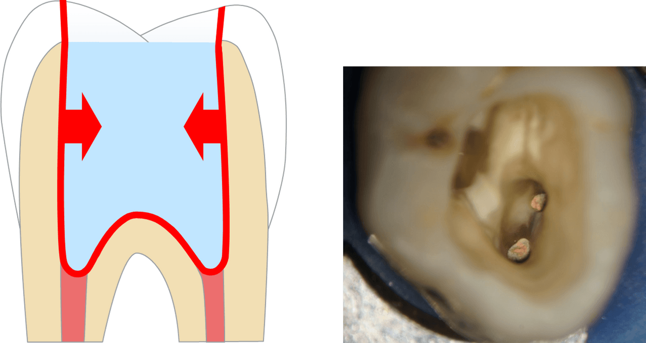 Large quantities of filling material need to be placed in posterior post-endodontic cavities, which can create significant shrinkage stress through the amount of bonded surfaces