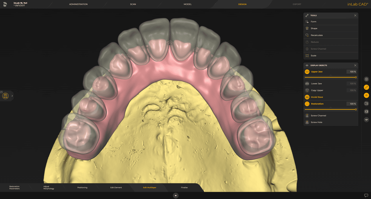 Encía multicapa para separar la estructura del elemento gingival y la estructura de la carilla, para proyectos de diseño de puentes que involucran la encía.