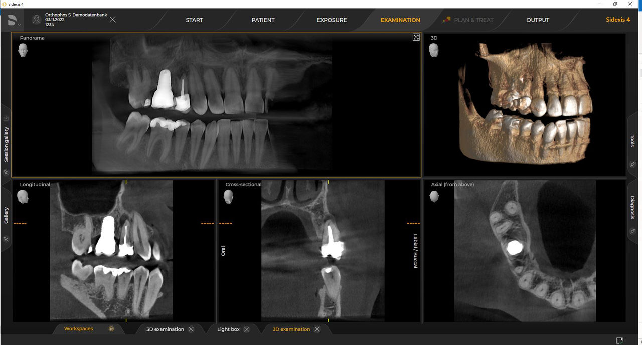Caso de radiografía dental de 5 cm x 5,5 cm HD de 80 μm