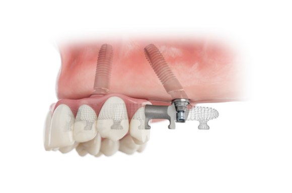 Full-Arch fixed implant prosthesis