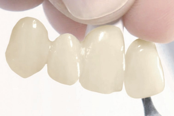 Dental Lab All-Ceramic Veneering Systems