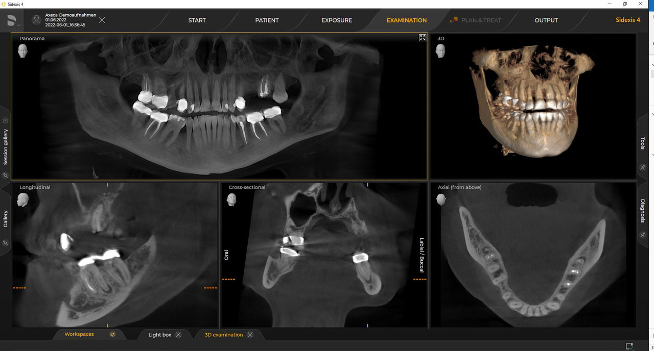 Radiographie 3D HD Ø 11 cm x 10 cm HD
