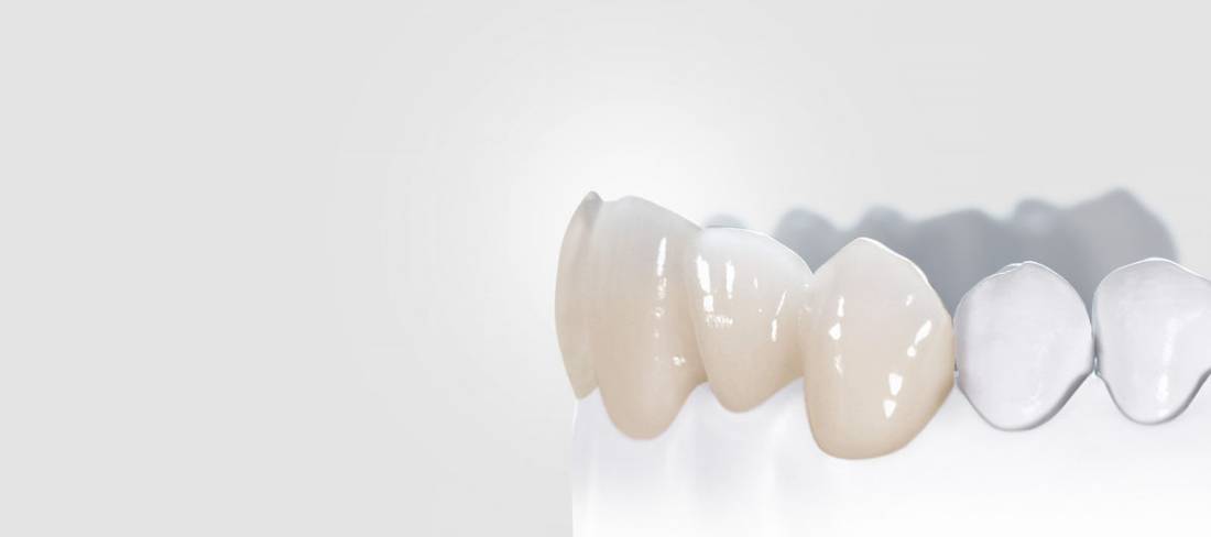 Dents Antérieures En Porcelaine Dentsply Solarex - Modèle 520 / B3, Pour Laboratoire Dentaire