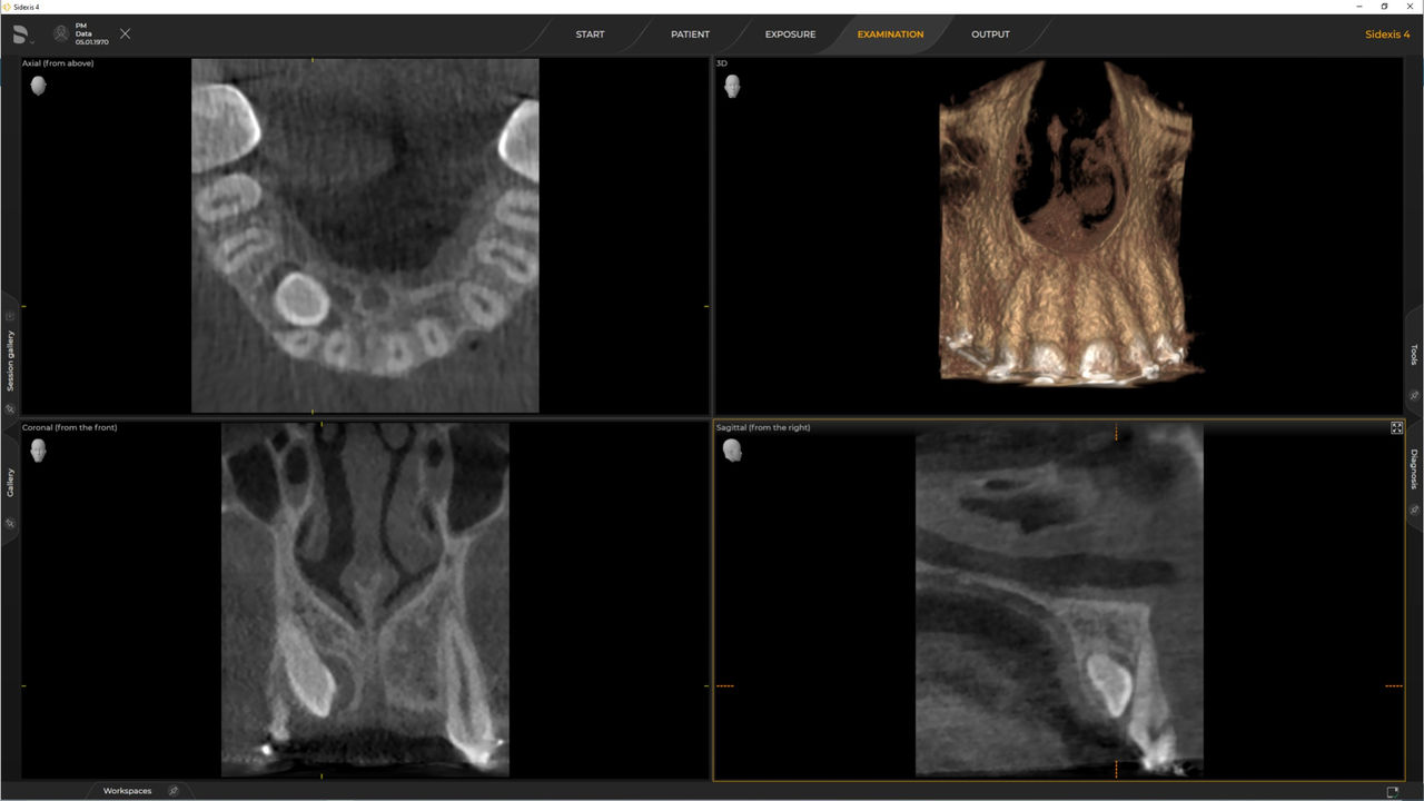 Radiographie dentaire d’un cas d’implant