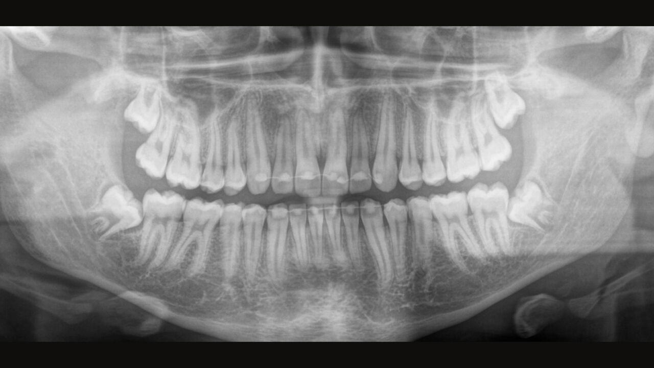 Image d’une radiographie extra-orale