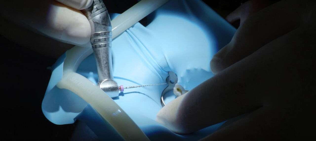 Close-up of dental handpiece used during endodontic treatment procedure