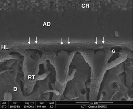 SEM on over dried dentin reflecting gaps within the resin-dentin interface