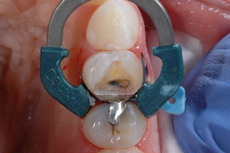 RES-image-class-II-isolation-of-restorative-field-palodent-plastic-wedge.jpg