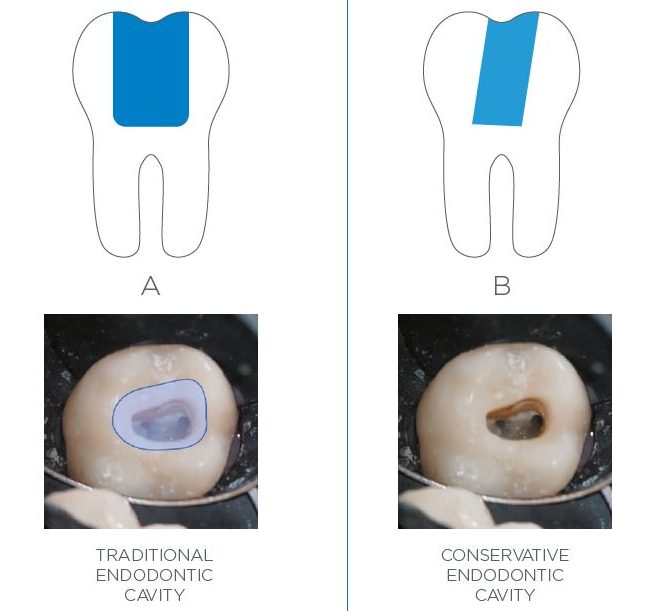 END-Graphics-TruNatomy-endodontic-cavity