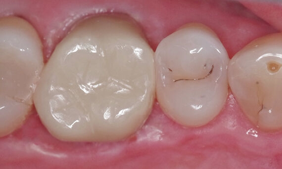 Crown, tooth 16, CEREC Zirconia, Todd Ehrlich