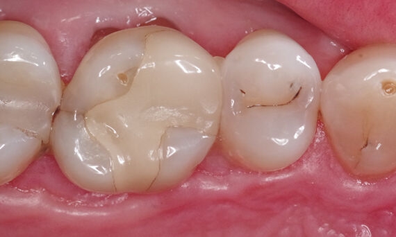 Large carious lesion on distal surface of tooth 16, 16-year-old onlay