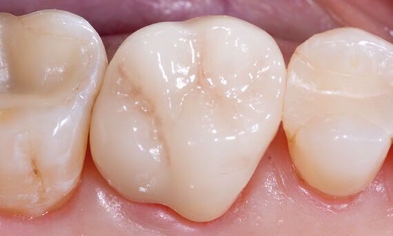 Crown, tooth 16, IPS e.max CAD, Caryn Halpern