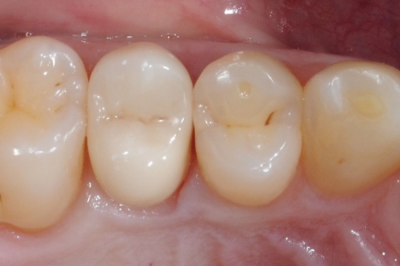 CEREC Tessera inlay, tooth 26