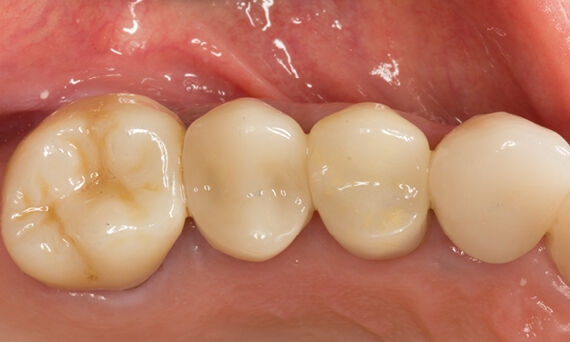 Translucent crown, tooth 14, Katana Zirconia STML, Mike Skramstad