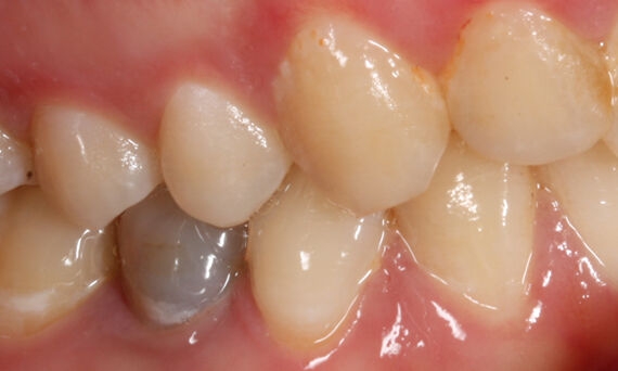 Discoloured tooth 45 