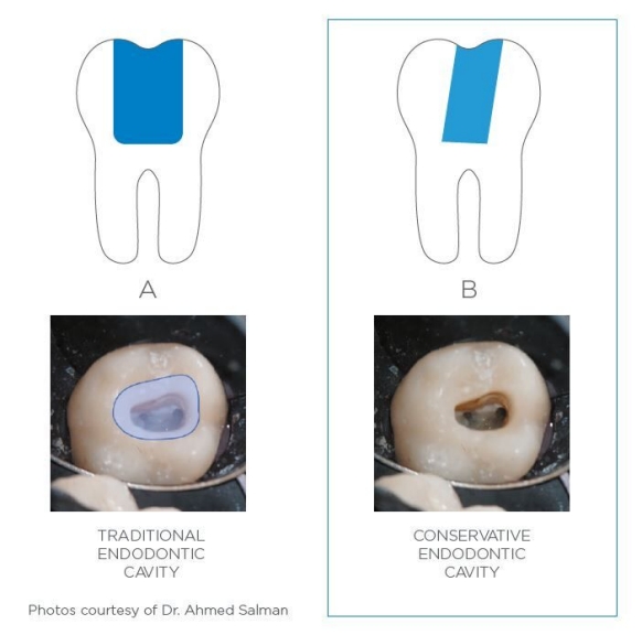 Image of traditional endo cavity vs conservative endo cavity from Dr. Salman