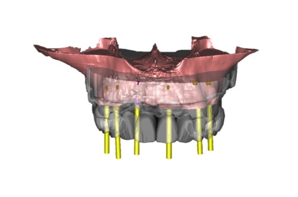 Full-arch dental implant treatment planning